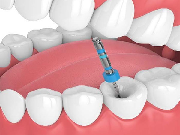 Single Sitting Root Canal